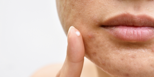 11 Acne Tips from an Esthetician