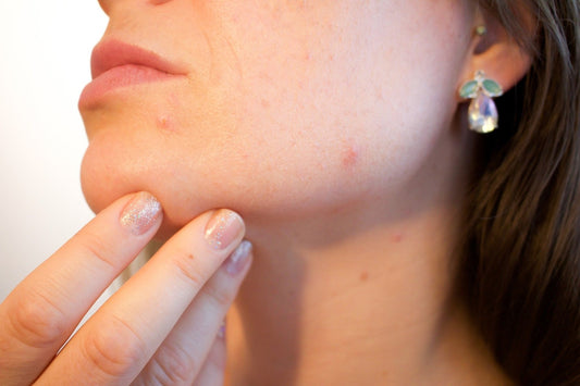 Common Skin Lesions and How To Get Rid Of Them