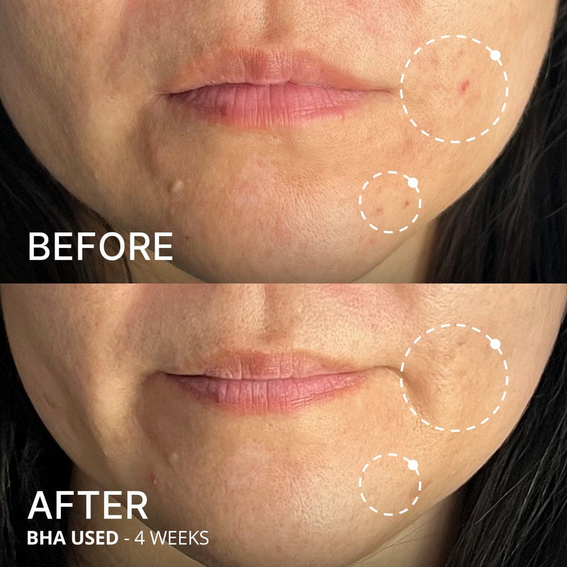 Side-by-side comparison of a woman's lower face before and after using BHA for 4 weeks. The "before" image shows more visible redness and blemishes, while the "after" image shows clearer, smoother skin with reduced redness