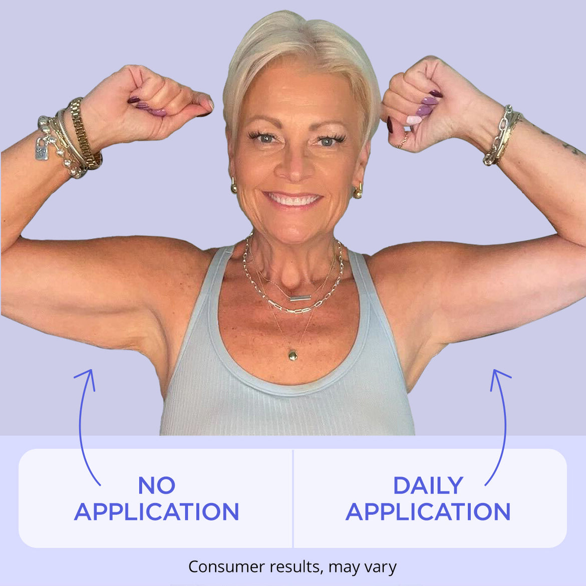 Side-by-side comparison of an arm before and after using a product, highlighting reduced skin sagging and improved firmness. Text reads “Before” and “After.” A disclaimer below says “Consumer results, may vary.”