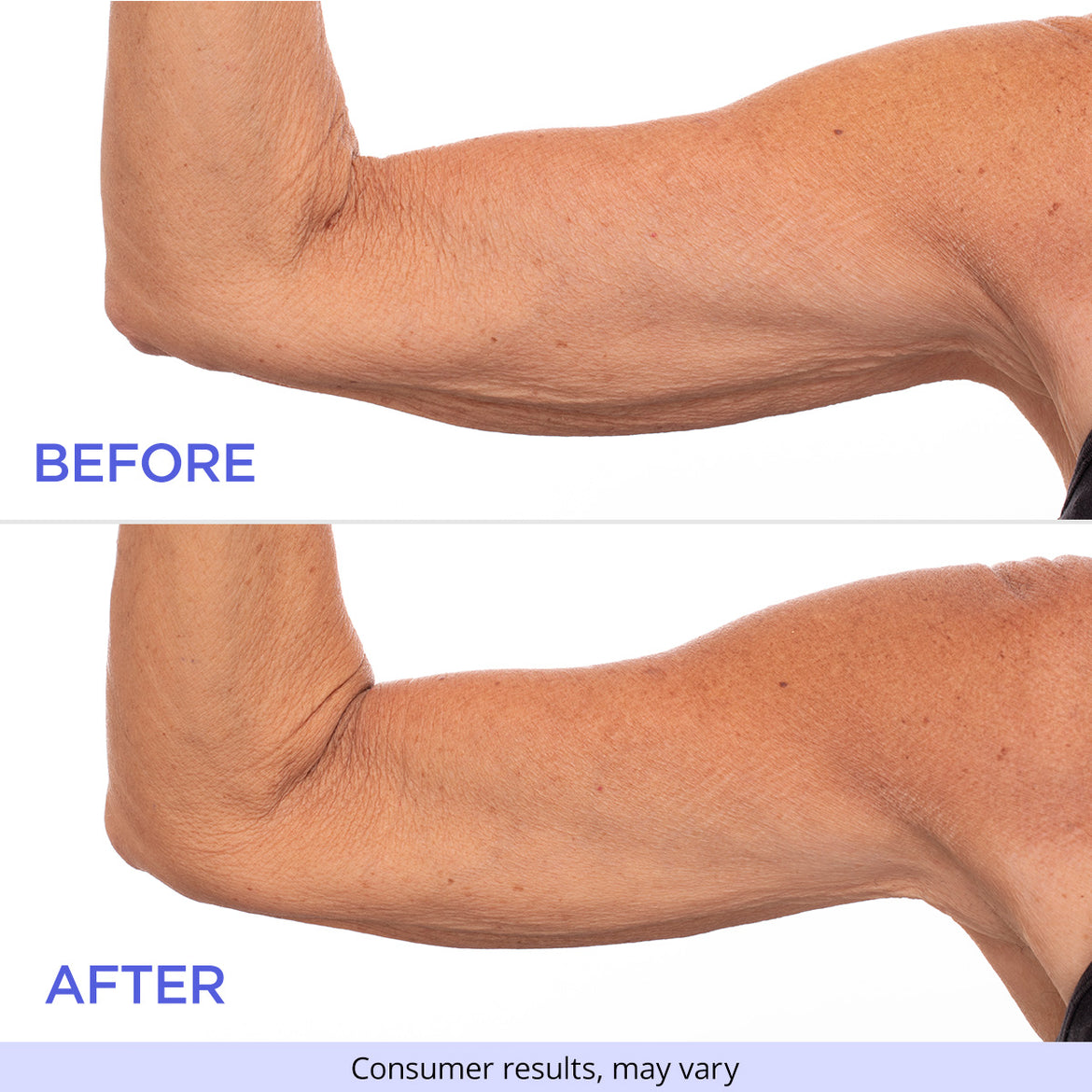 Close-up view of an arm before and after using the product, showing reduced crepiness and improved skin texture. Labels “Before” and “After” are displayed with a disclaimer “Consumer results, may vary.”