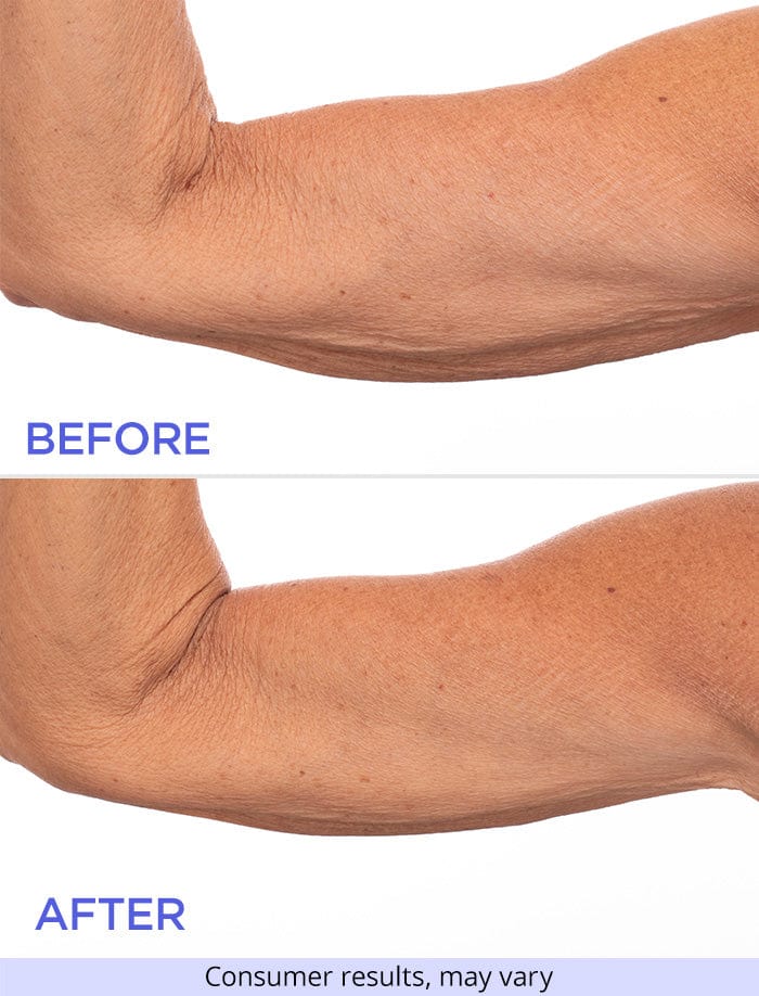 Close-up view of an arm before and after using the product, showing reduced crepiness and improved skin texture. Labels “Before” and “After” are displayed with a disclaimer “Consumer results, may vary.”