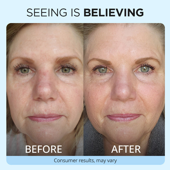 A side-by-side “before and after” close-up of a woman’s face, showing visible skin improvements. The text reads “Seeing is Believing” with a disclaimer about consumer results varying.