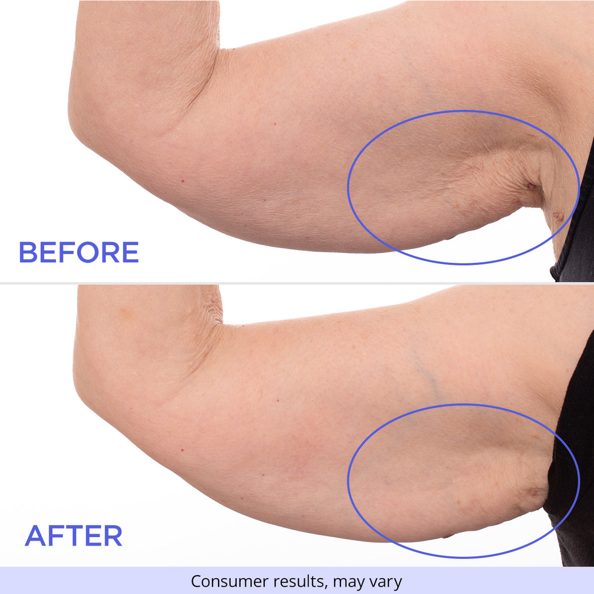 Side-by-side comparison of an arm before and after using a product, highlighting reduced skin sagging and improved firmness. Text reads “Before” and “After.” A disclaimer below says “Consumer results, may vary.”