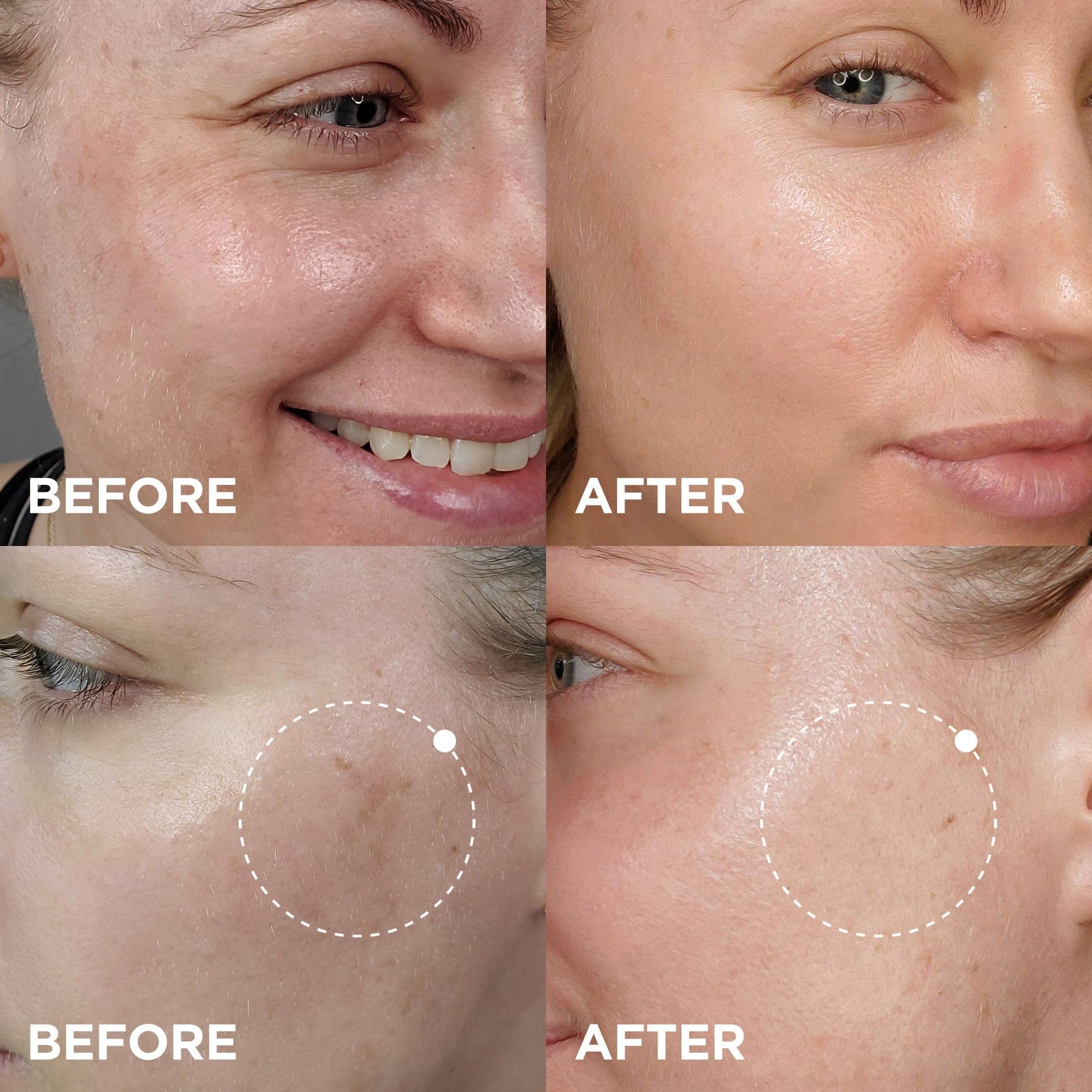 Quadrant of images showing a woman's face and close-up of skin under the eye, labeled 'BEFORE' and 'AFTER' treatment, highlighting reduced wrinkles and smoother skin texture